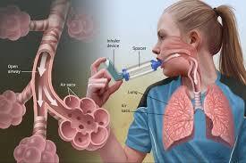 بیماری آسم و نقش باکتری‌ها در بروز آن